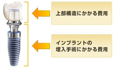 上部構造にかかる費用、インプラントの埋入手術にかかる費用